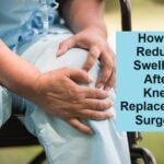 How to Reduce Swelling After Knee Replacement Surgery